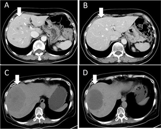 Efficacy of Transarterial Chemoembolization on Lesion Reduction in Colorectal Liver Metastases {faces}